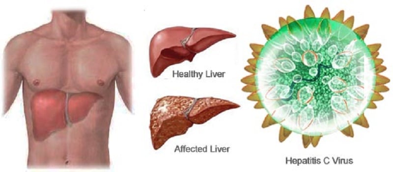 10 Essential Facts About Hepatitis C : Human N Health