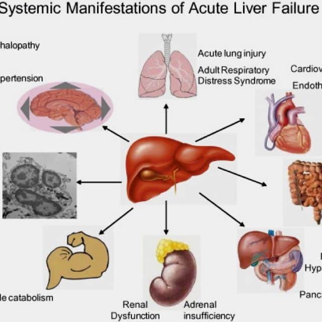27 best images about Stages Of Liver Damage on Pinterest