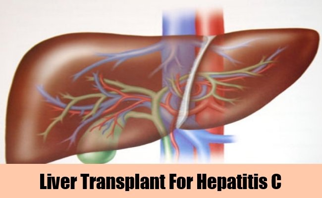 5 Treatments For Hepatitis C â Natural Home Remedies ...