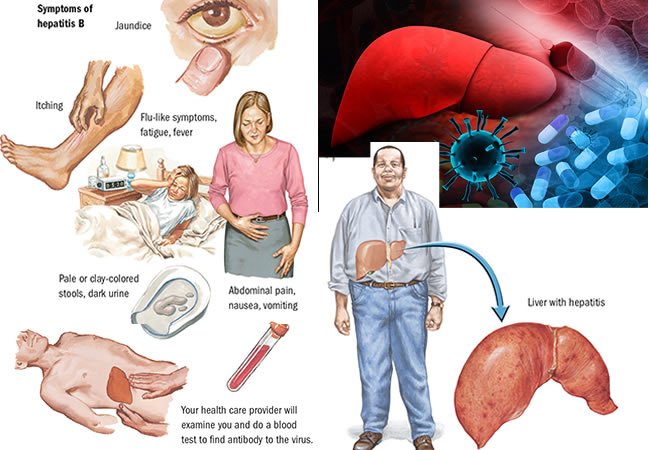 8 symptoms of hepatitis B you mustnât ignore