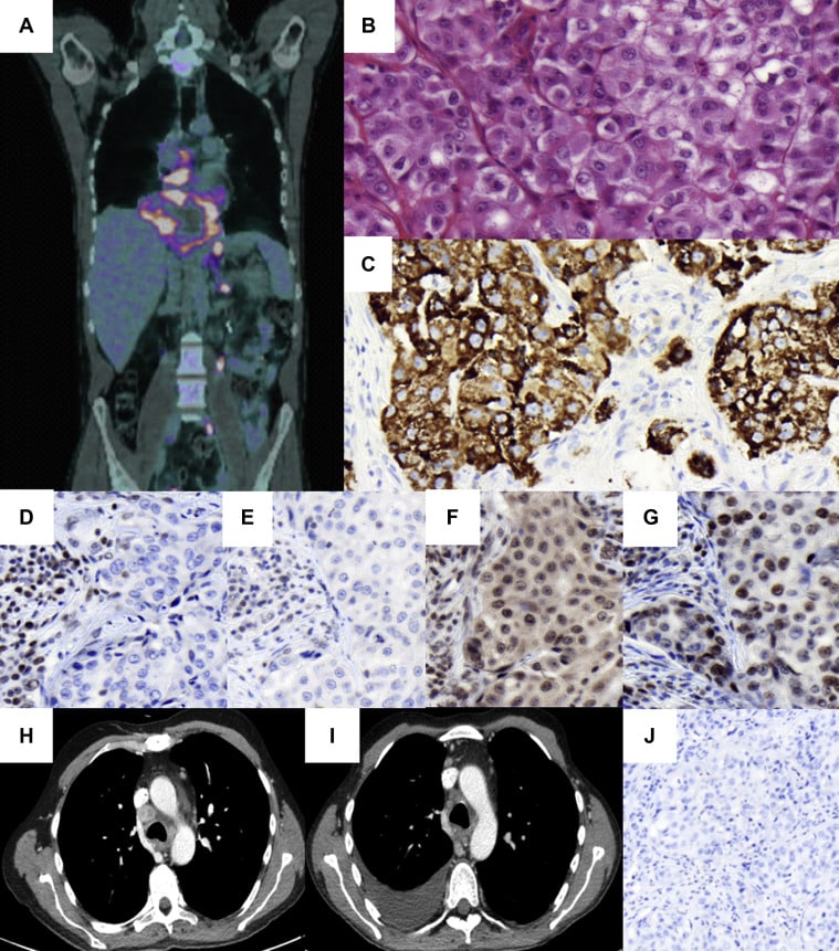 A Mismatch RepairâDeficient Hepatoid Adenocarcinoma of the Lung ...