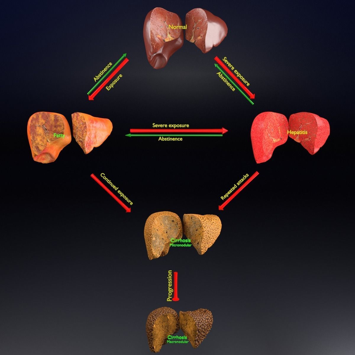 Alchoholic liver disease cirrhosis hepatitis 3D model