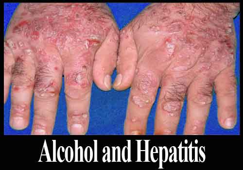 Alcoholic Hepatitis