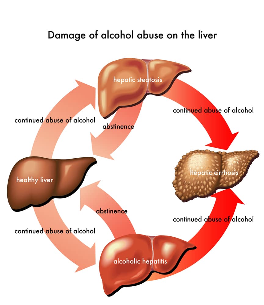 Alcoholic liver disease photo