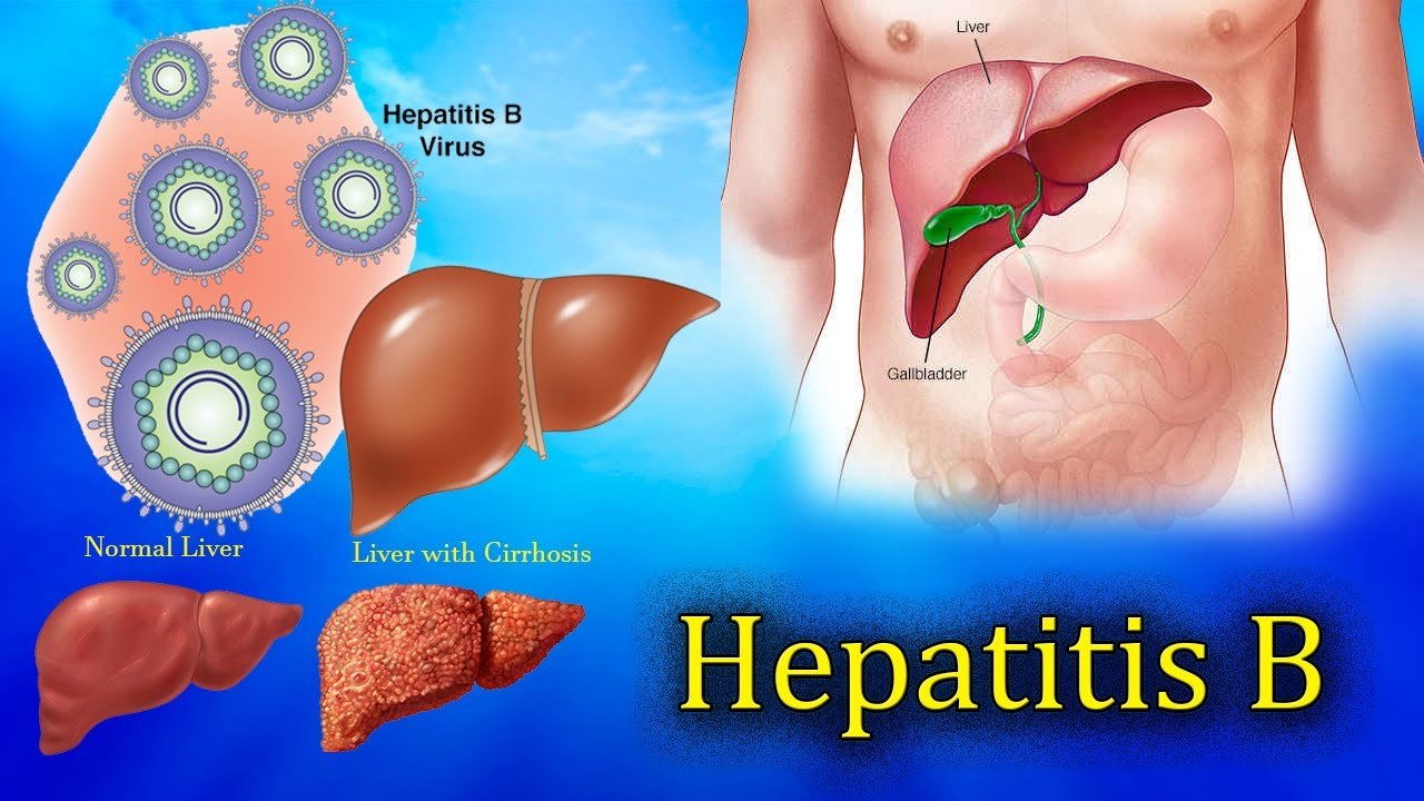 All You need to Know About Hepatitis B : e