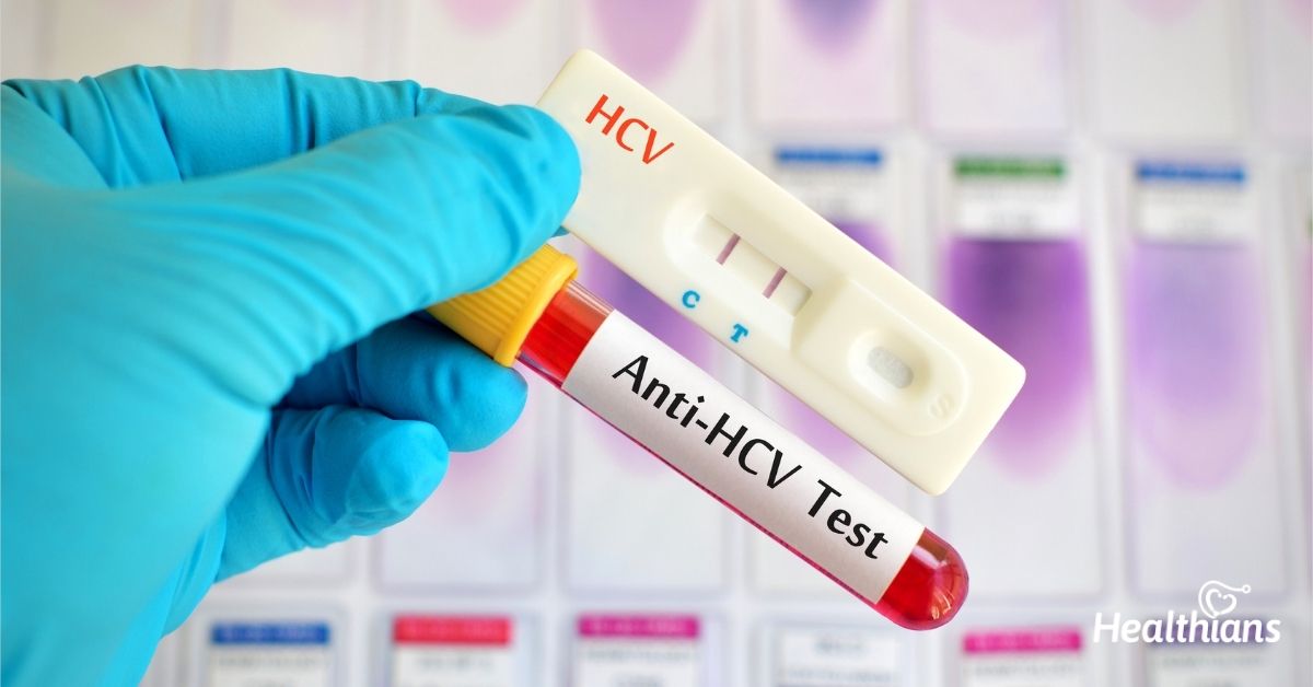 Anti HCV test: How does it detect hepatitis C infection?