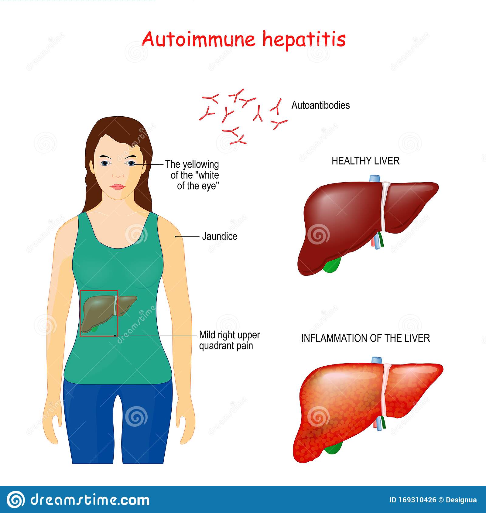 Autoimmune Hepatitis. Autoimmune Disease Stock Vector