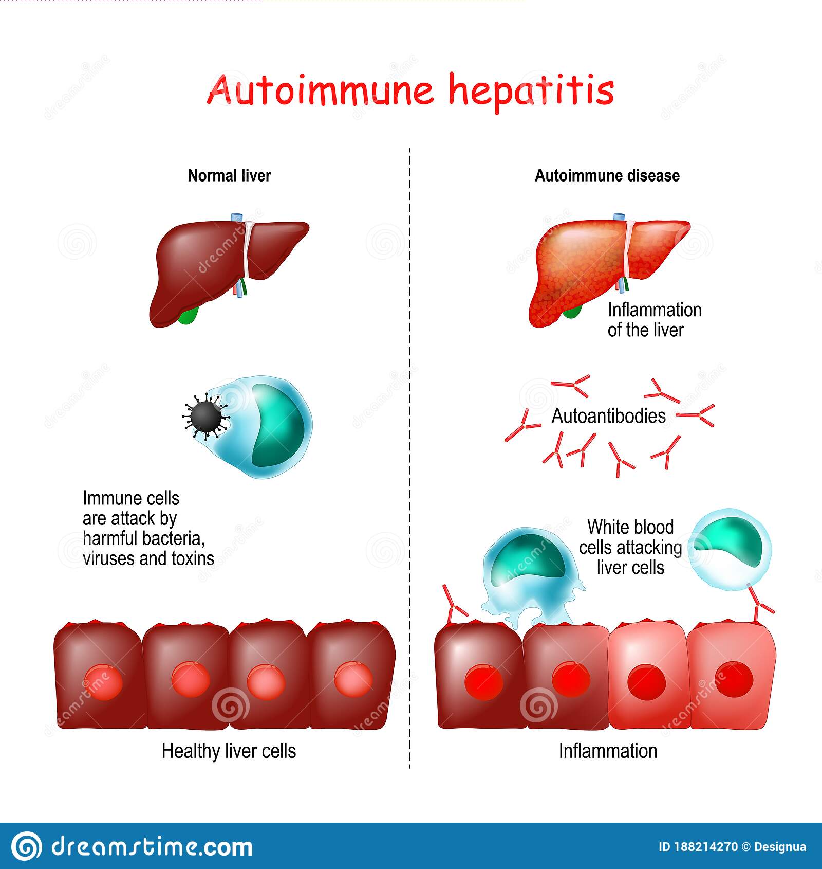 Autoimmune hepatitis stock vector. Illustration of human