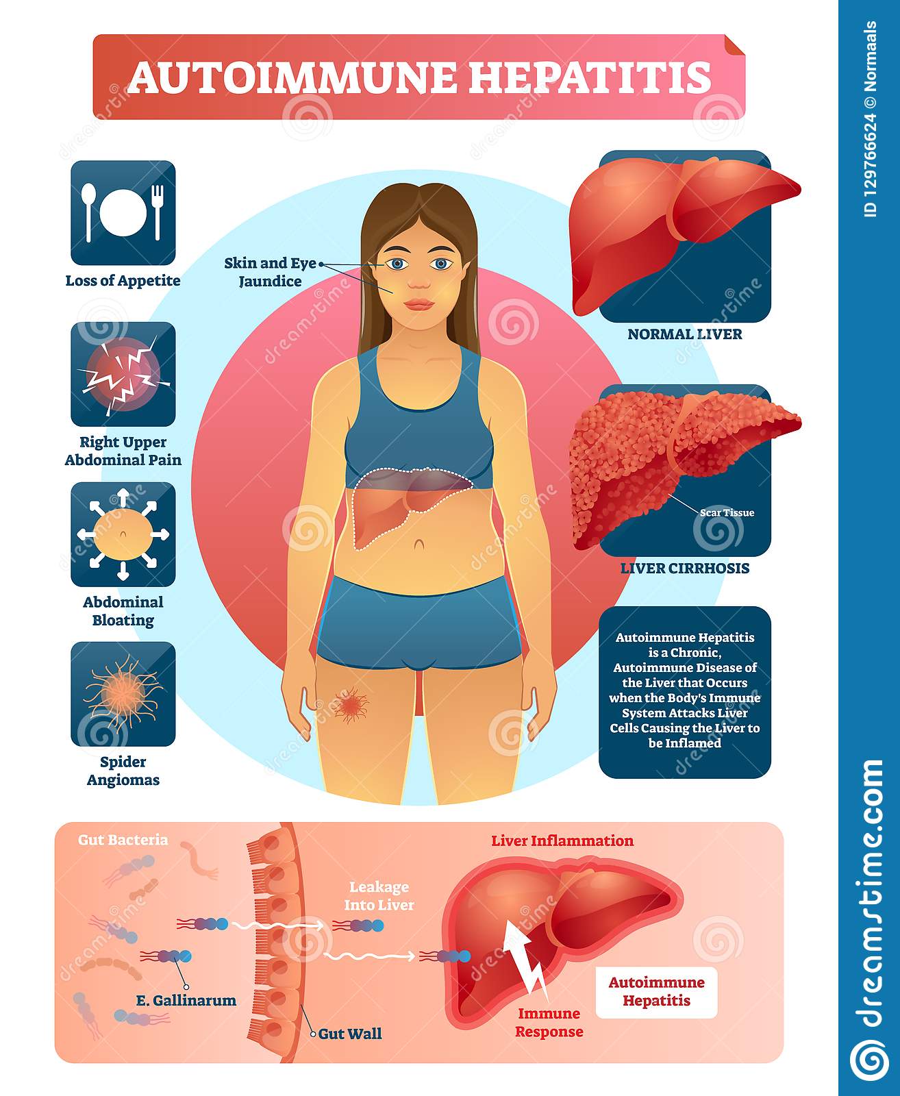 Autoimmune Hepatitis Vector Illustration. Labeled Diagram With Disease ...