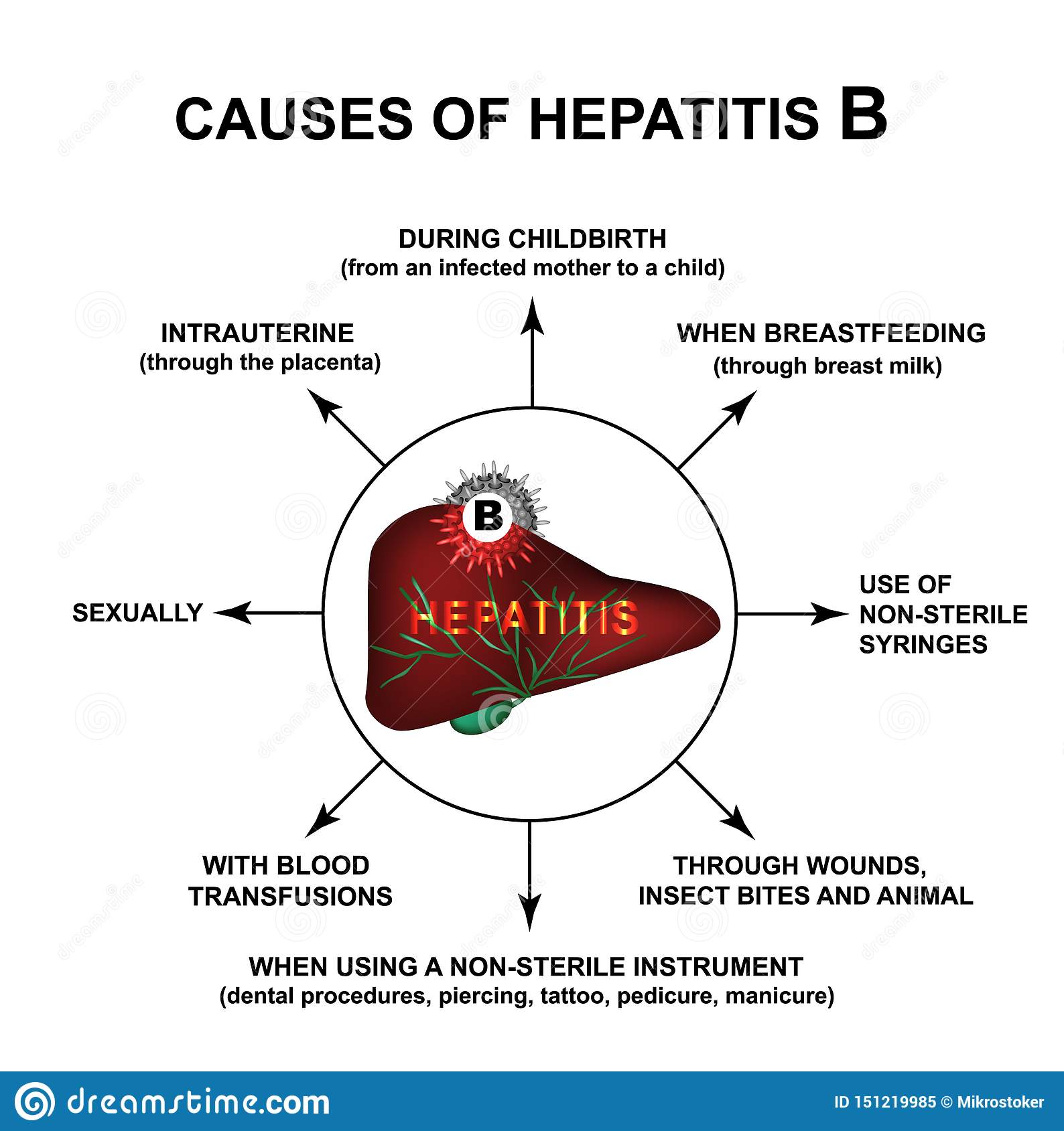 Causes of Hepatitis B. World Hepatitis Day. Infographics. Vector ...