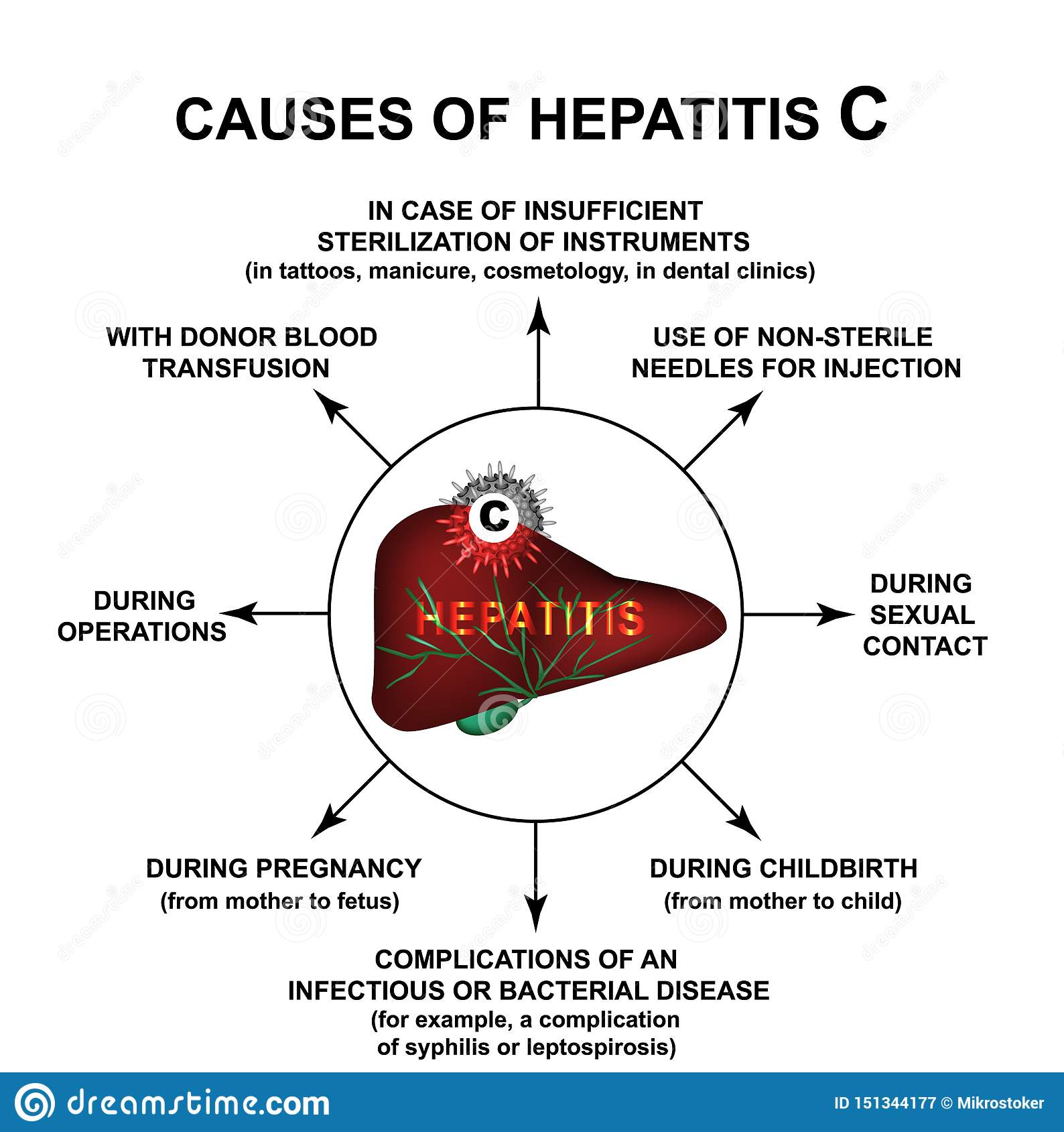 Causes Of Hepatitis C World Hepatitis Day Infographics Vector ...