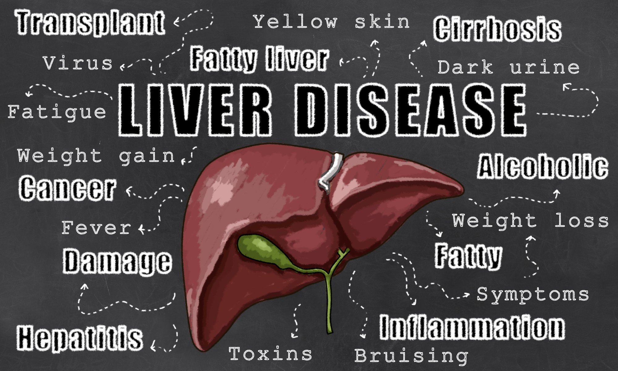 Causes of Liver Disease