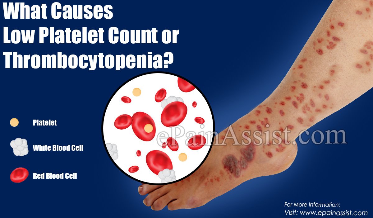 Causes Of Low Platelet Count or Thrombocytopenia, Its Effects &  Ways To ...