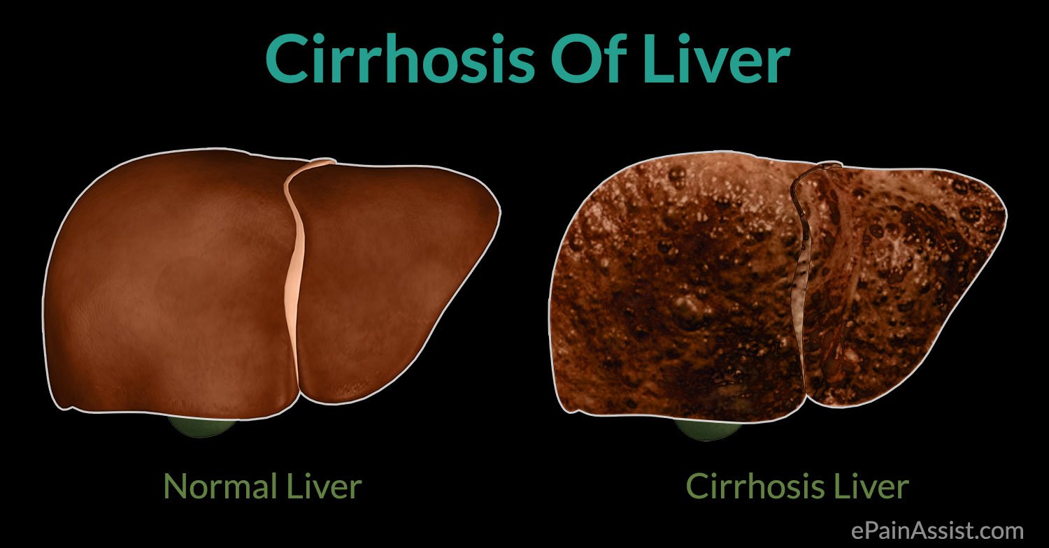 Cirrhosis Of Liver: Causes, Symptoms, Treatment, Complications