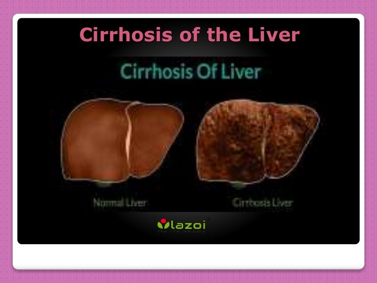 Cirrhosis of the liver