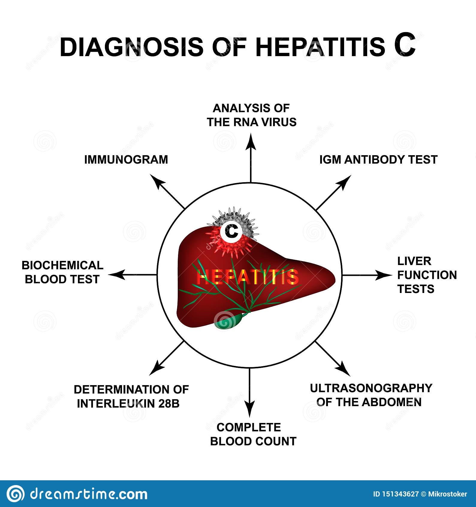 Diagnosis Of Hepatitis C World Hepatitis Day Infographics Vector ...