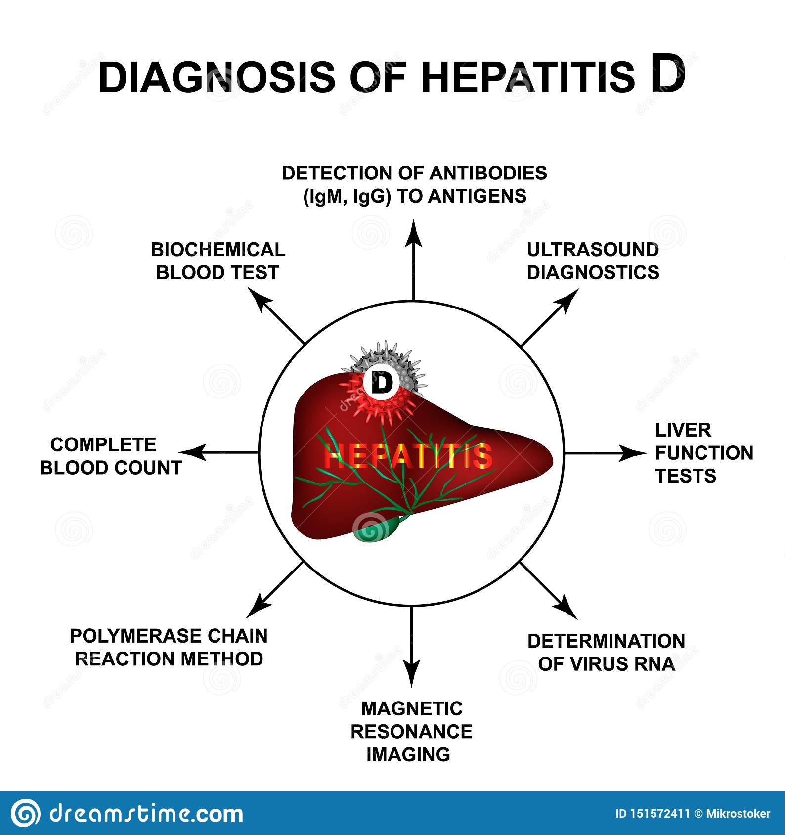 Diagnosis Of Hepatitis D. World Hepatitis Day. Infographics. Vector ...
