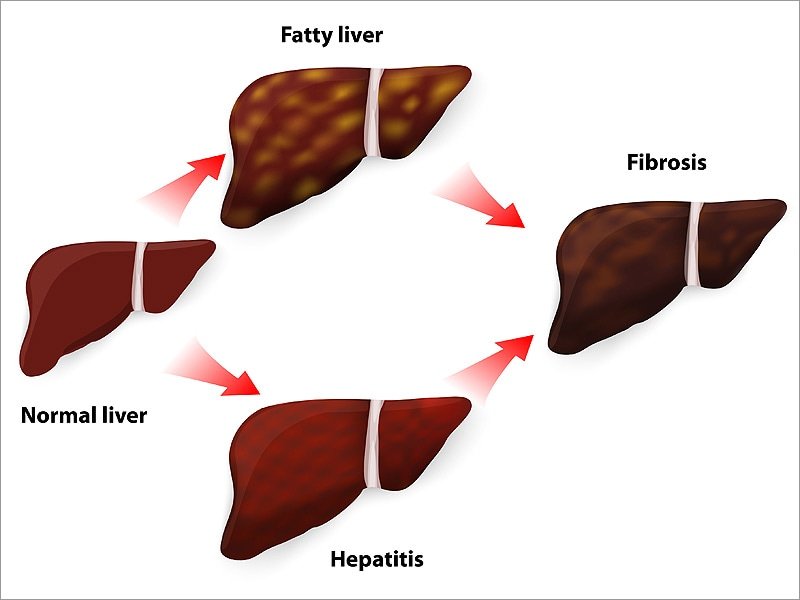 Fatty Liver Common After Direct
