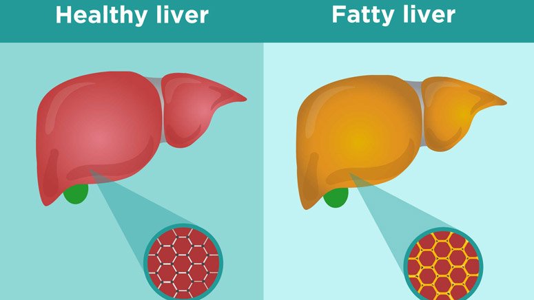 Fatty Liver (Hepatic Steatosis): Most Common Signs and Symptoms â Page ...