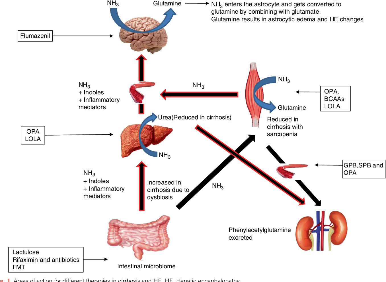 Figure 1 from Current Management of Hepatic Encephalopathy ...