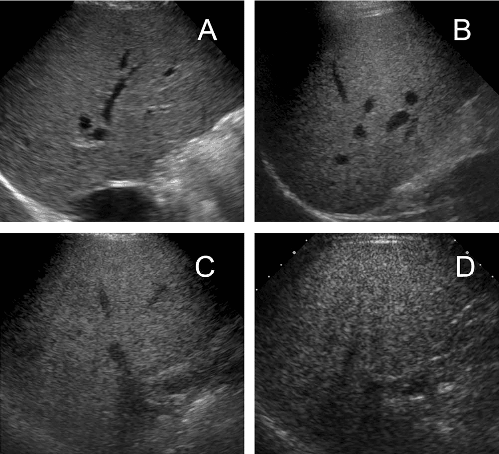 Figure 1 from Sonography Predicts Liver Steatosis in Patients With ...
