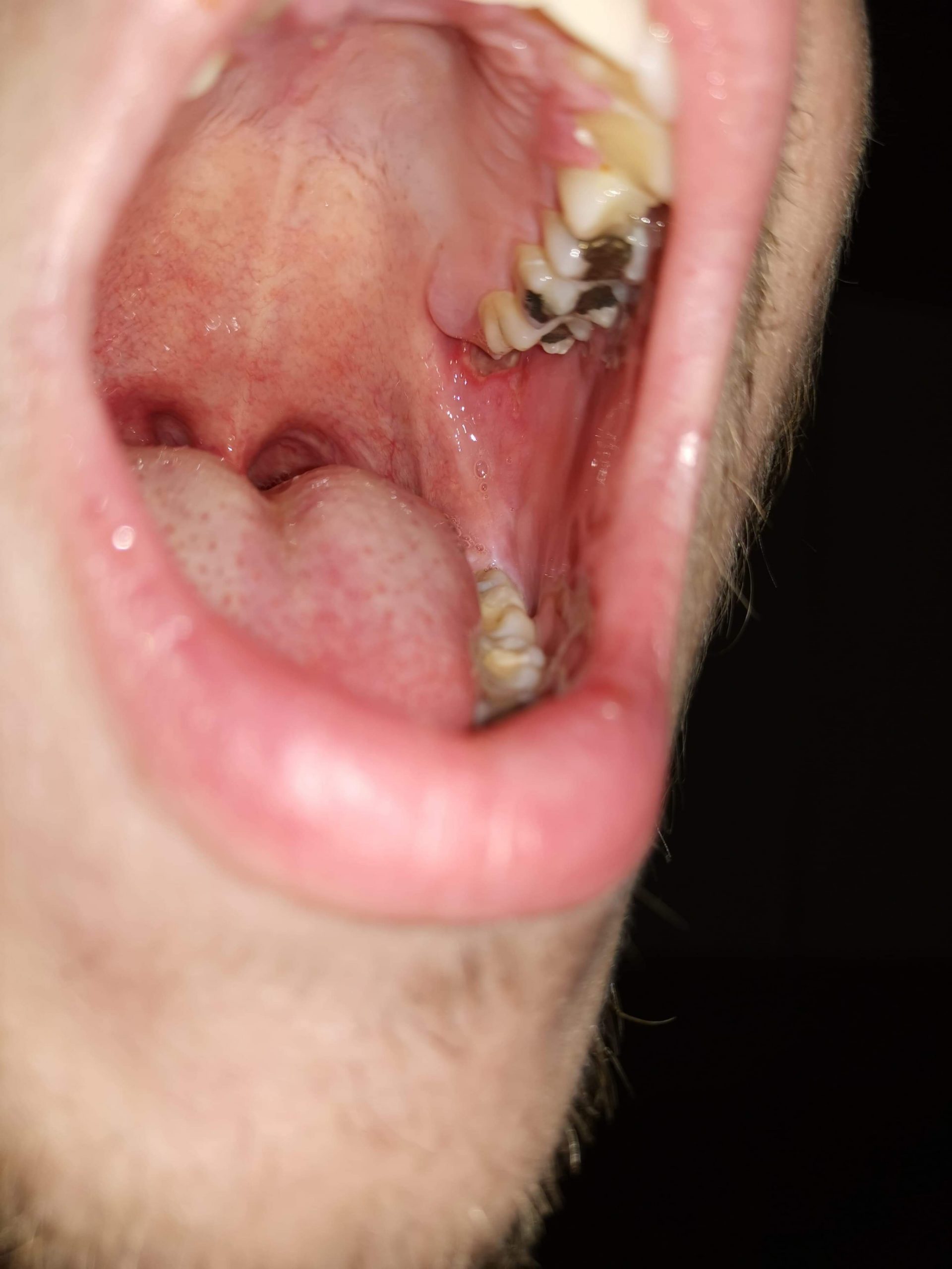 Guys, please help! Wisdom tooth made me a crater like hole ...