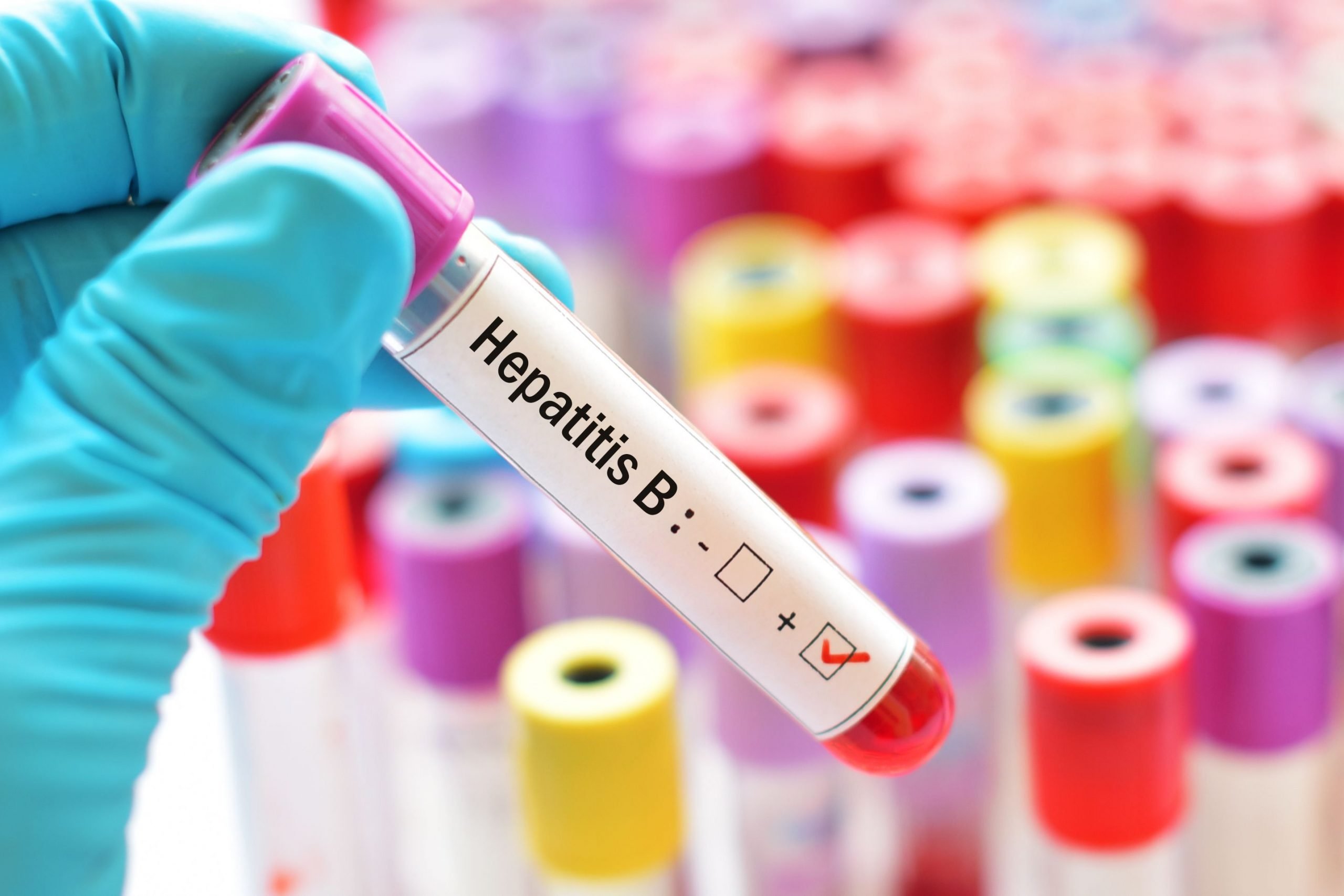 HBsAg or Hepatitis B Surface Antigen Test