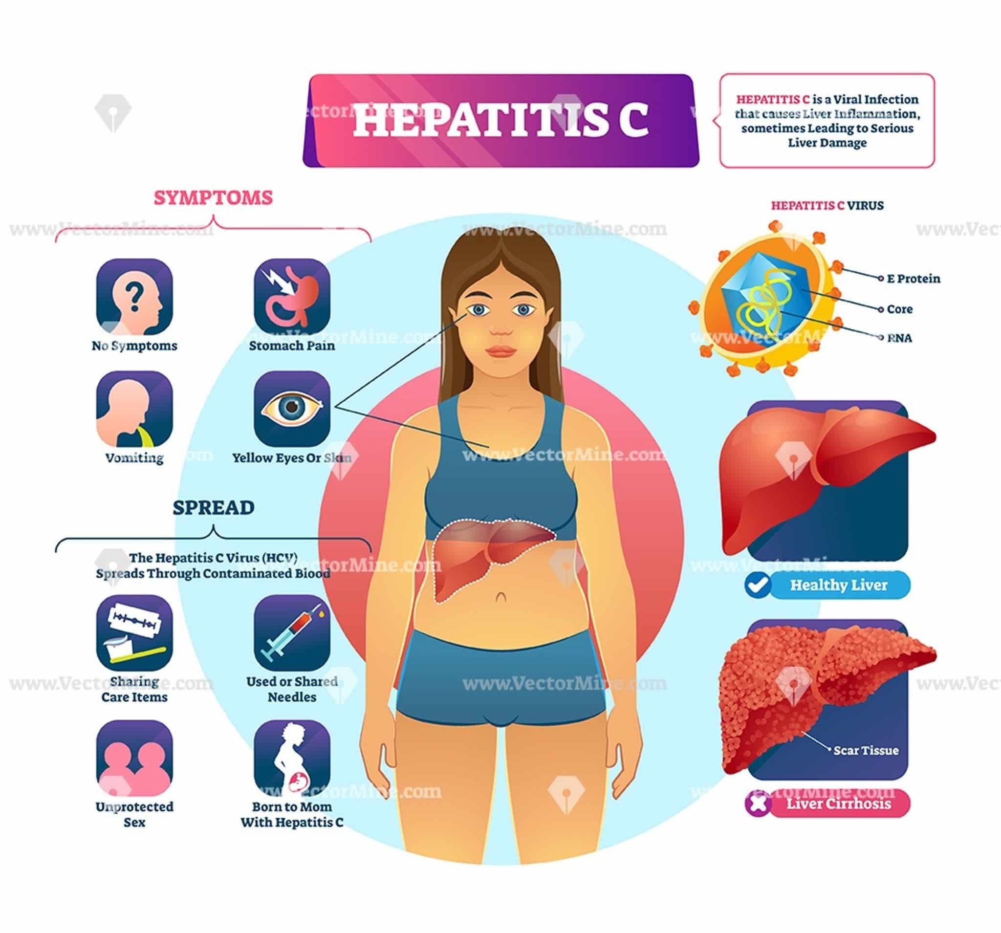 Hcv signs and symptoms: Hepatitis C â Diagnosis and treatment