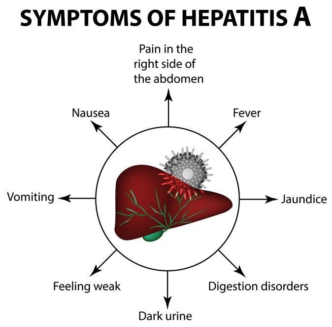 Hepatitis A outbreak among population of San Diego