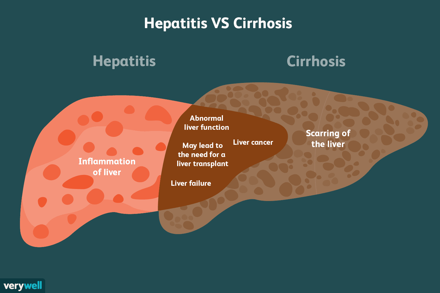 Hepatitis and Cirrhosis Similarities and Differences