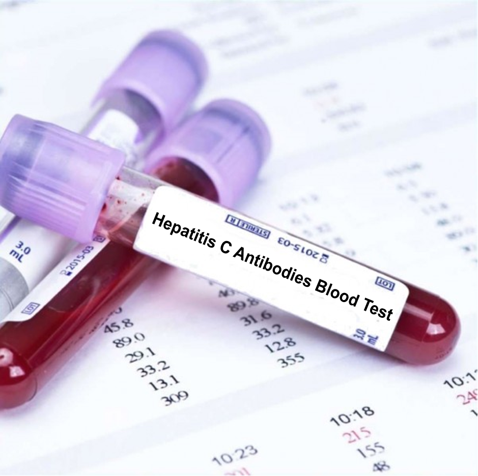 Hepatitis C Antibodies Blood Test