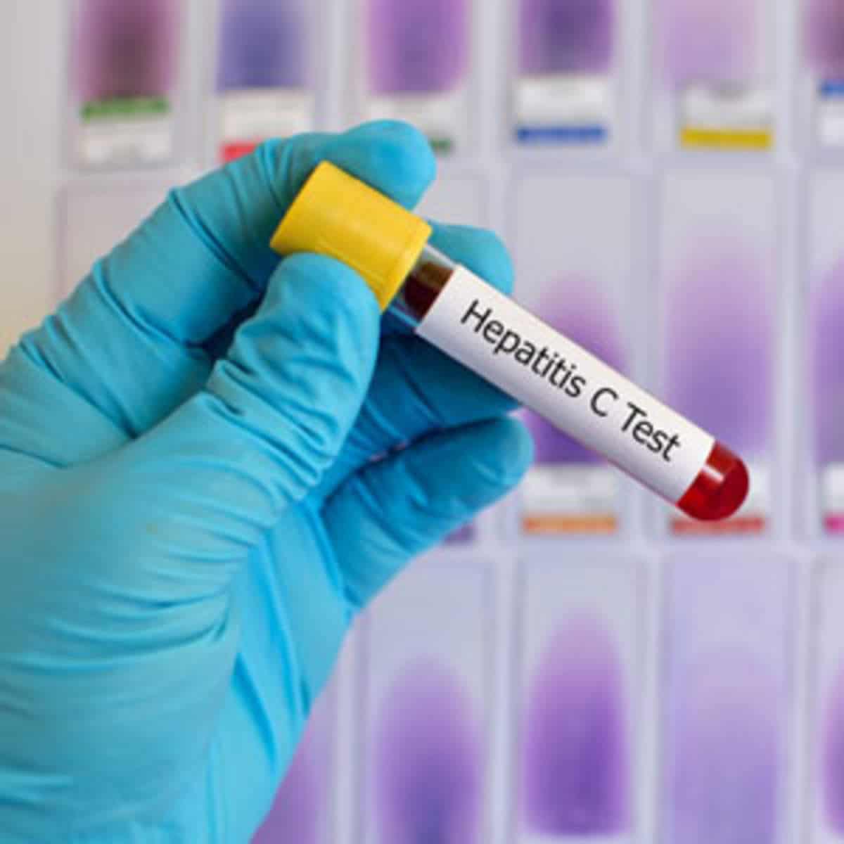 Hepatitis C Antibody Testing of MSM at STI Clinic Yields More Cases Faster