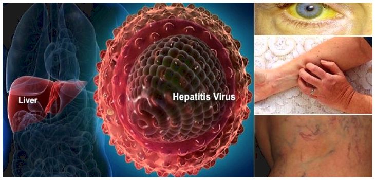 Hepatitis c signs and symptoms and results in  mayo ...