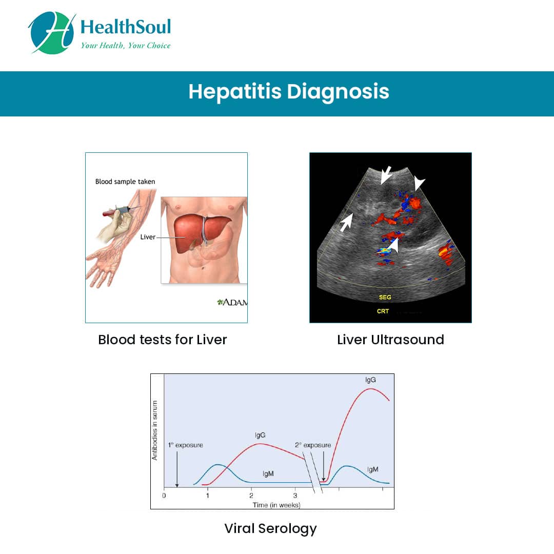 Hepatitis: Causes, Symptoms and Treatment  Healthsoul