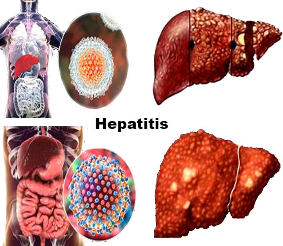 Hepatitis: Types, Symptoms, Causes, Diagnosis, Treatment, and Prevention.
