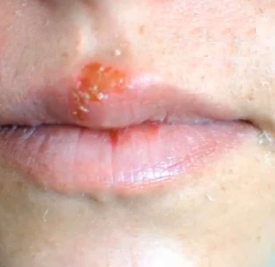 Herpes vs Cold sores are they different? You