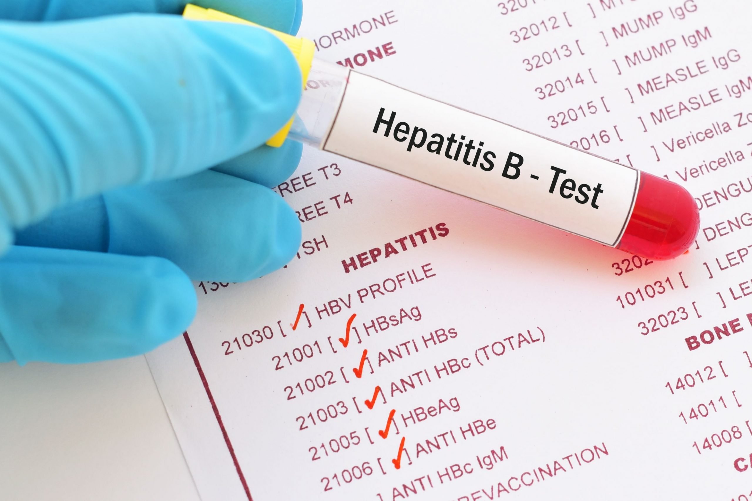 How Do I Get Tested for Hepatitis B/HBV?