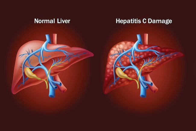 How Hepatitis C Affects Your Body â Getilapson
