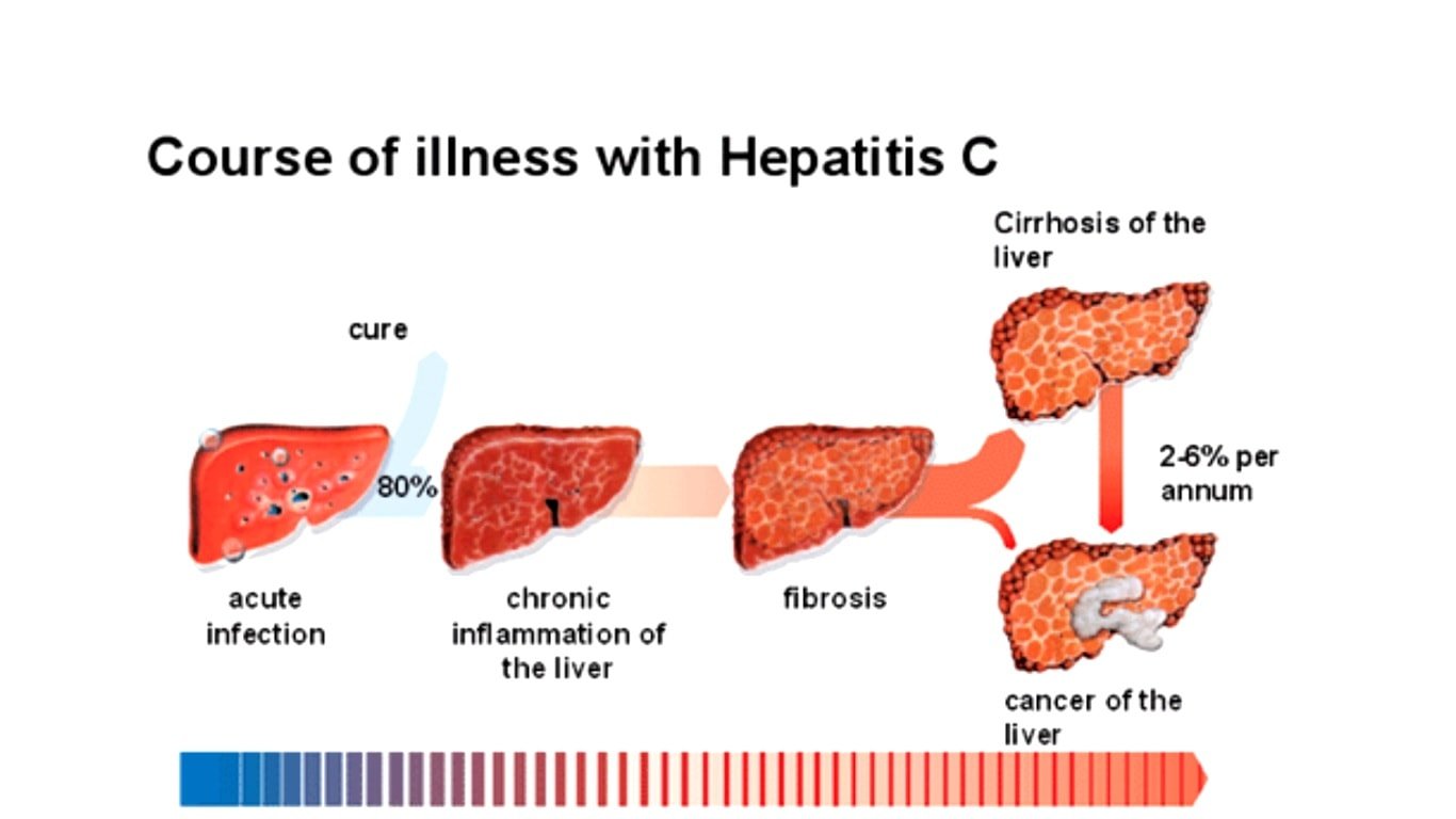 How is Hepatitis C transmitted and Why is Hepatitis C more dangerous ...