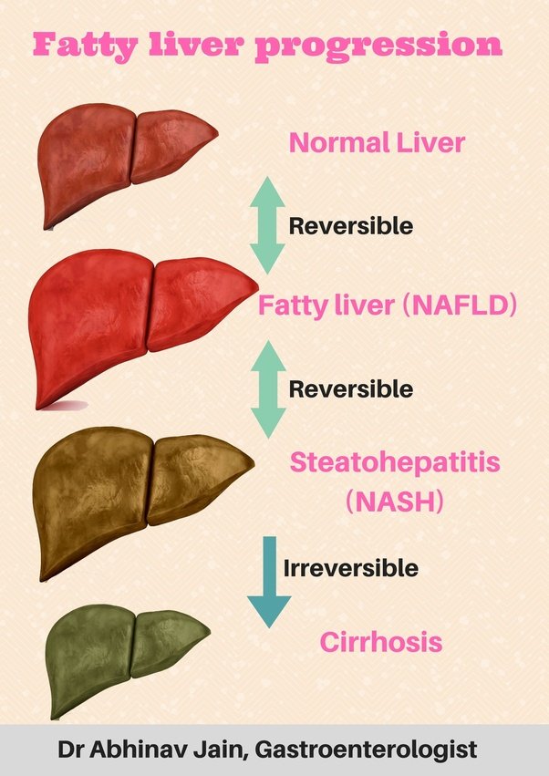 How much time does it take to reverse a fatty liver, grade ...