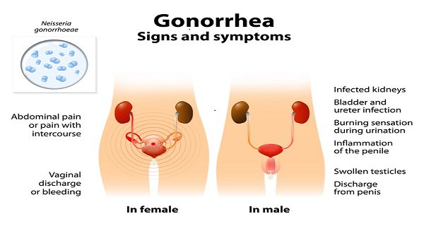How Serious Is Gonorrhea And What Are The Symptoms ...