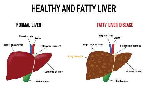 I am diagnosed with fatty liver grade