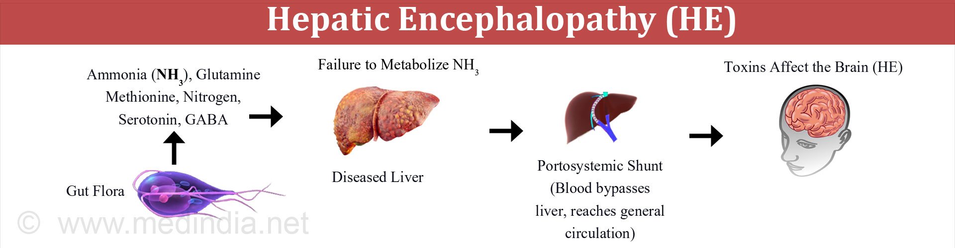 Information on hepatic encephalopathy