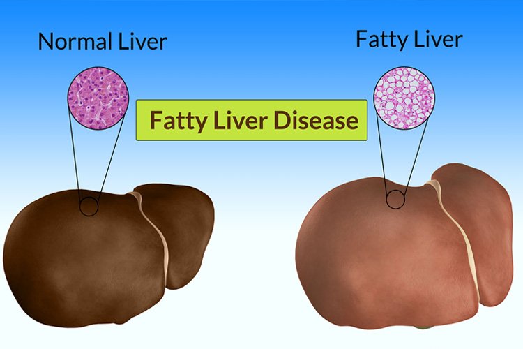 Knowing About Fatty Liver  Causes, Signs, Symptoms