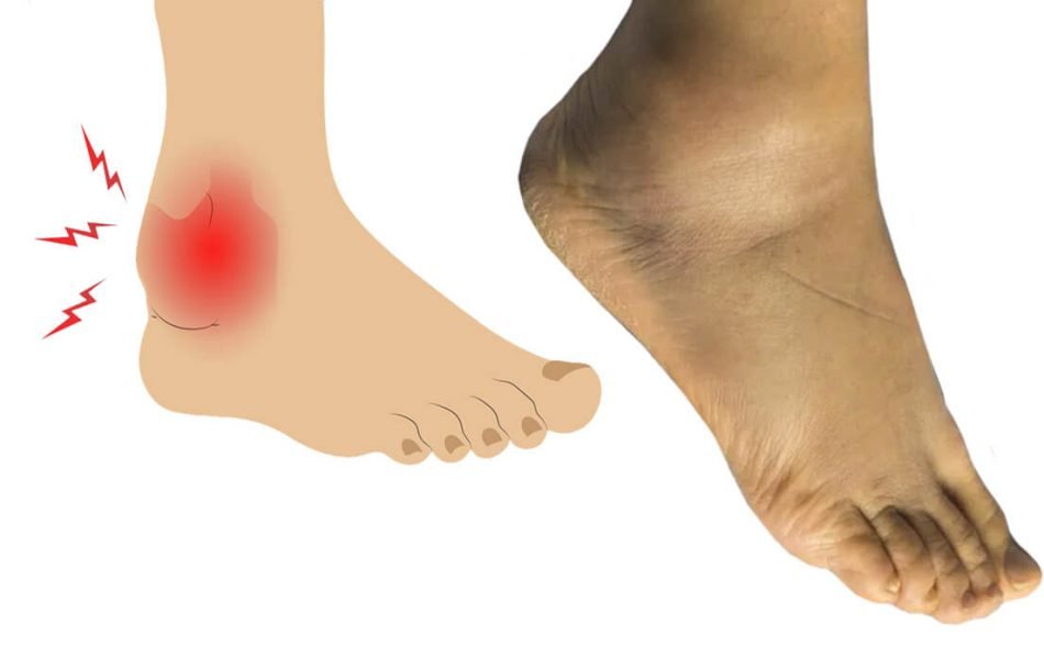 Left Foot and Ankle Swelling: Symptoms, Causes, and Best ...