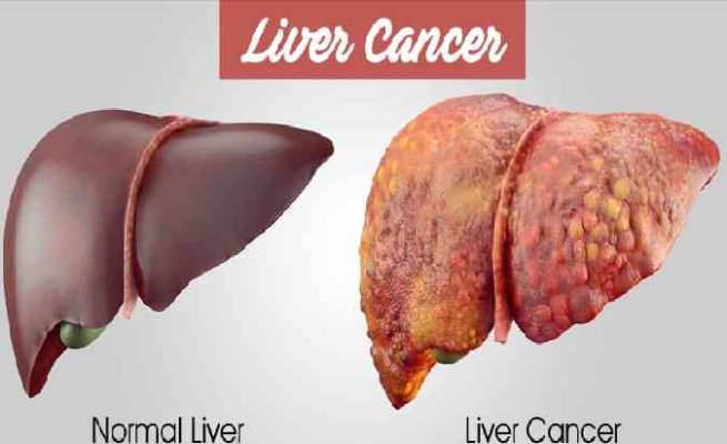 liver cancer (hepatocellular carcinoma) tends to occur in ...