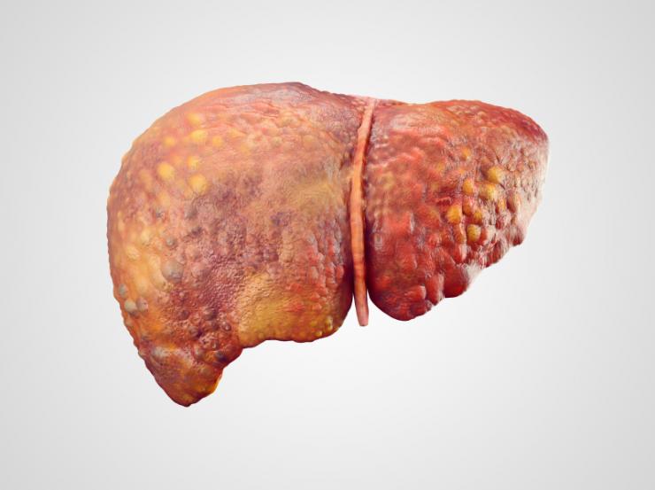 Liver cancer risk lingers after hepatitis B virus cleared ...