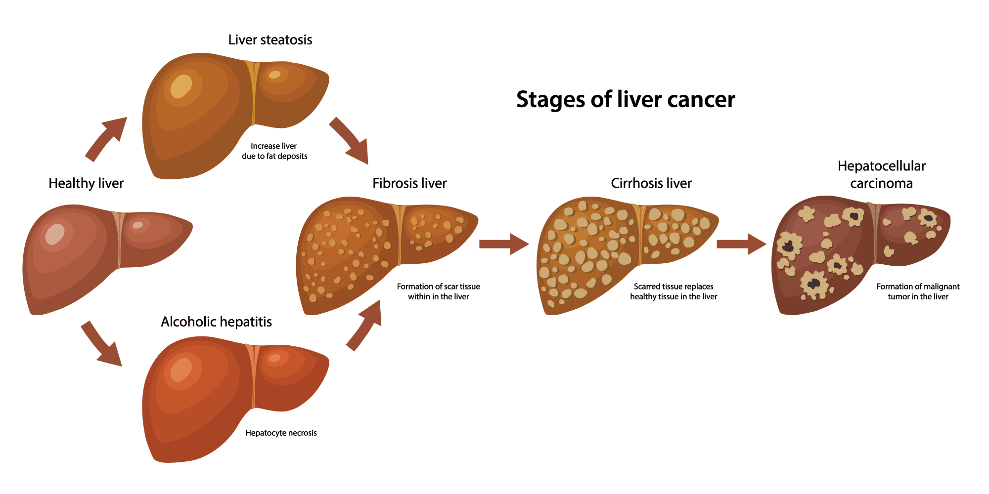 Liver Cancer Treatment in Anchorage