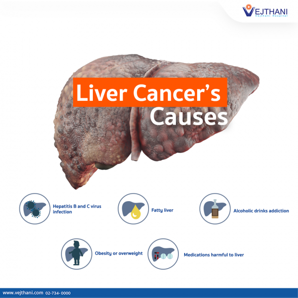 Liver Cancerâs Causes