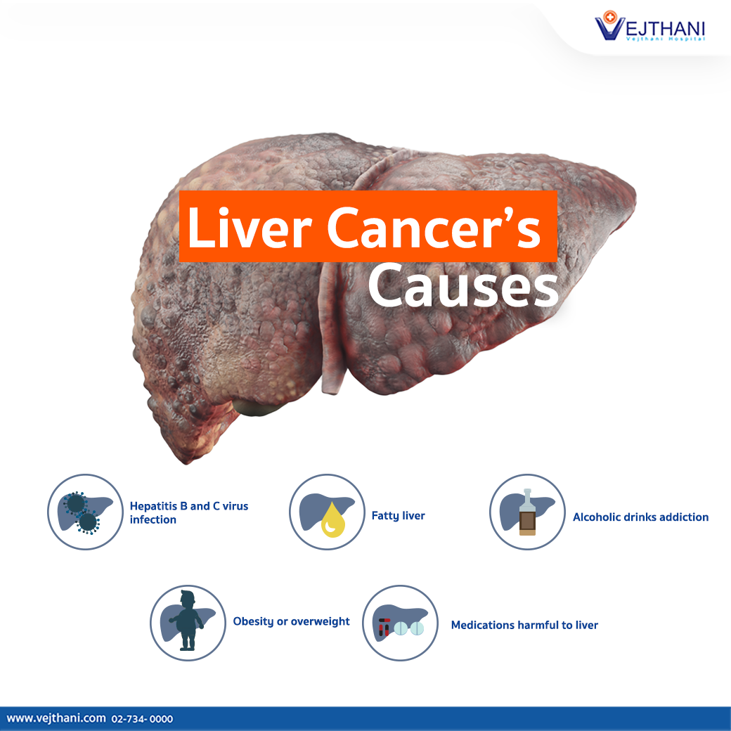 Liver Cancers Causes